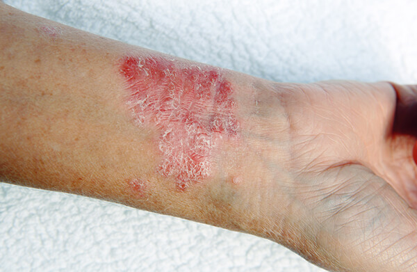 Red, scaly skin patch known as plaques on left wrist from psoriatic arthritis