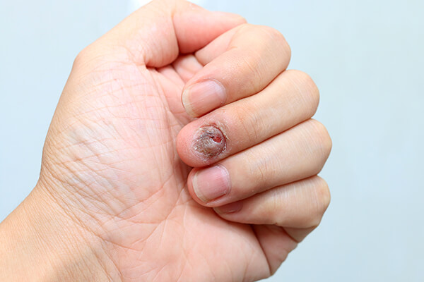Psoriatic arthritis in nails