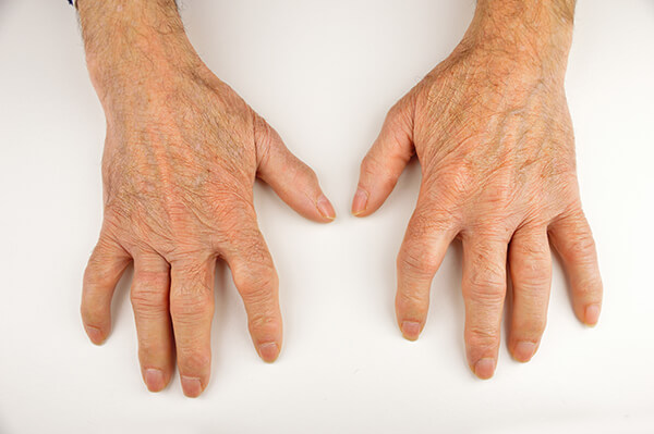 What causes psoriatic arthritis