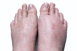 Swollen toes from psoriatic arthritis