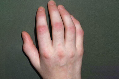 Hand with asymmetric arthritis
