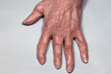 Hand with arthritis mutilans