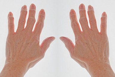 Hands with symmetric arthritis